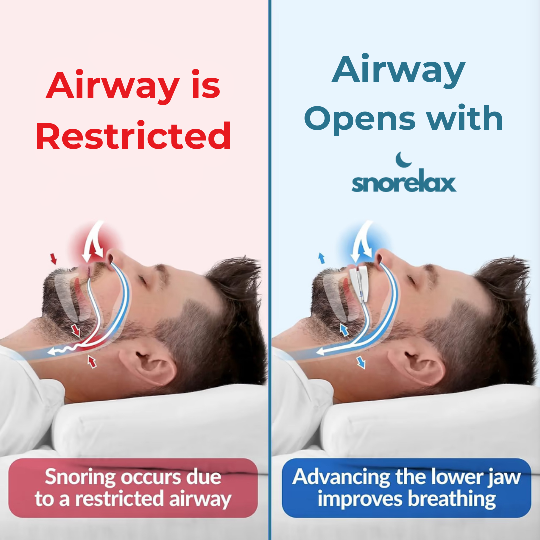 SnoreLax Pro Mouthguard - Bedding image 5