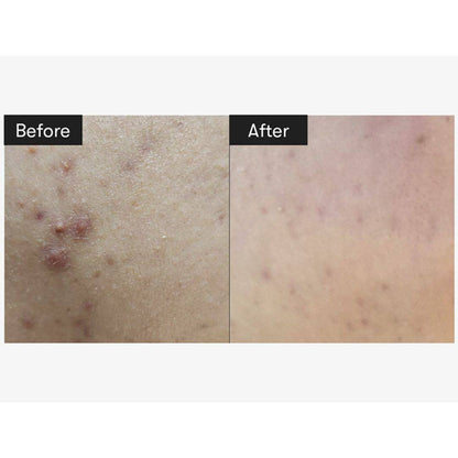 VT CICA Reedle Shot 100 - Accessories image 6